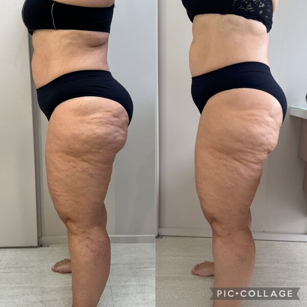Resultado lipedema lateral esquerda - Dra. Anna Abreu